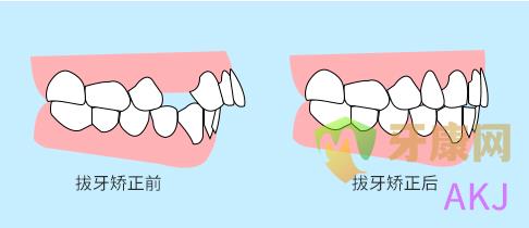 牙齿矫正