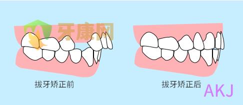 拔牙矫正