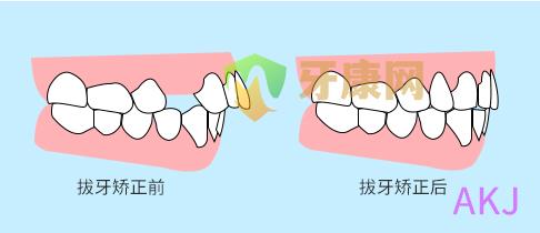 拔牙矫正