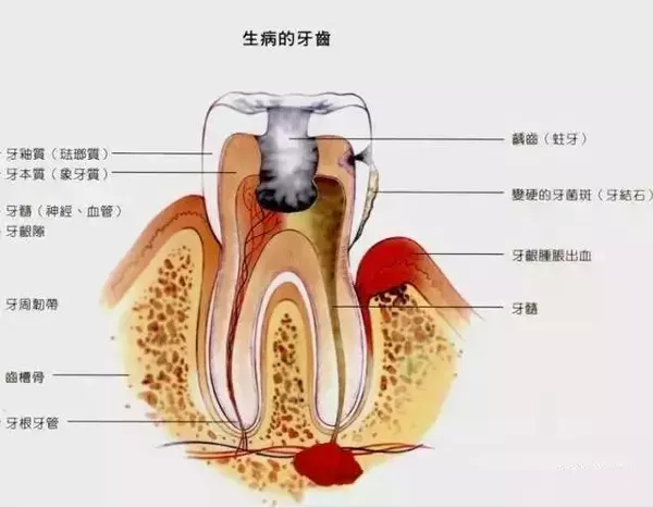 牙结石