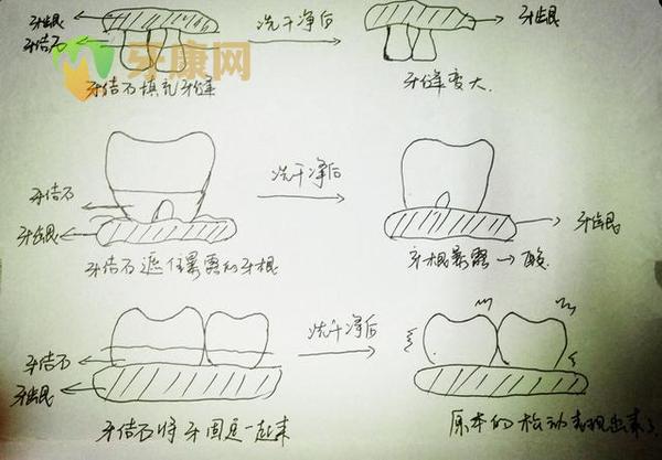 你敢洗牙吗？竟然被骗这么久？