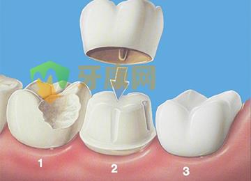 烤瓷牙套掉了该怎么办
