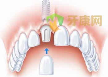 牙齿缺失的原因