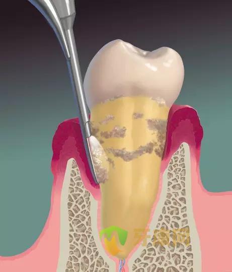 牙周病需要洗牙吗
