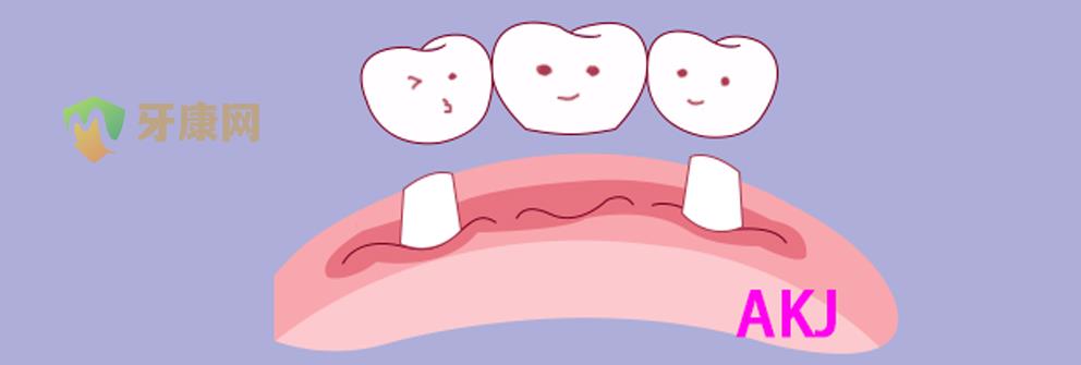 牙齿缺失后做烤瓷牙
