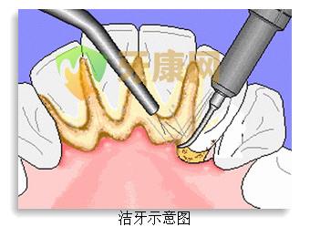 牙康网医生介绍：洗牙好不好？