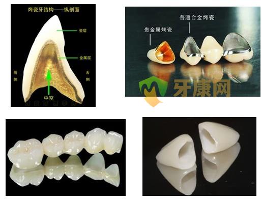 全瓷冠和烤瓷冠有什么区别？