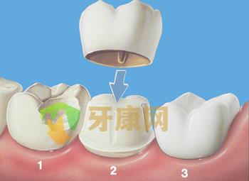 镶烤瓷牙没有牙根怎么办？