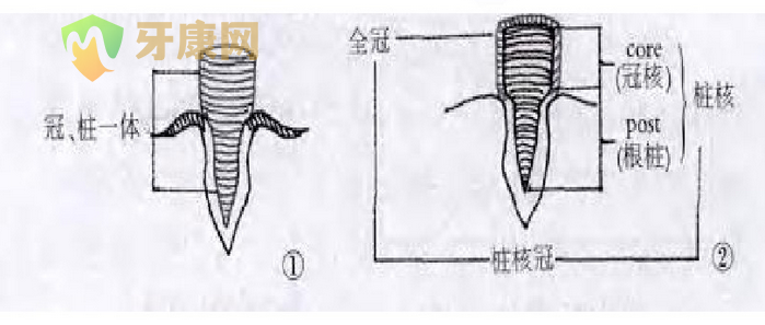 桩核冠修复多少钱？