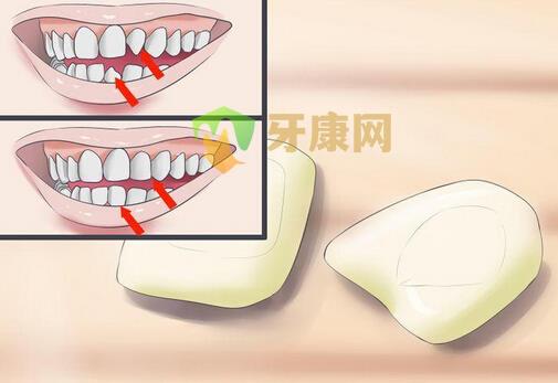 瓷贴面的美白结果好不好？