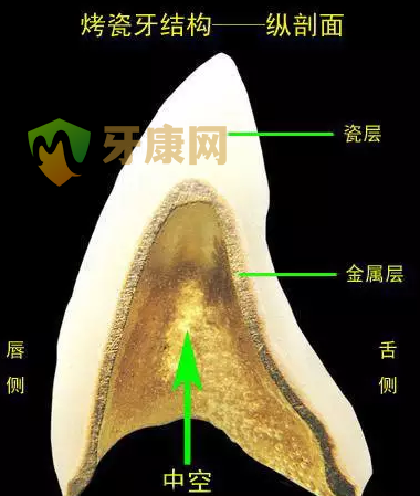 什么是钯银烤瓷牙？钯银烤瓷牙简介（全）