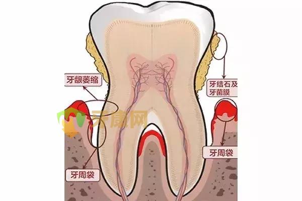 洗牙