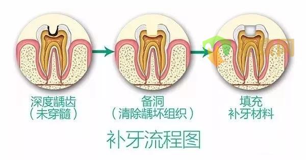 补牙