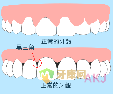 黑三角