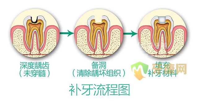 深圳正规医院补牙要多少钱