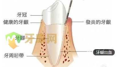 牙龈出血的原因