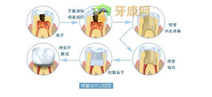 根管治疗的注意事项：