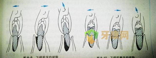 揭秘牙医拔牙，不要再上当了！