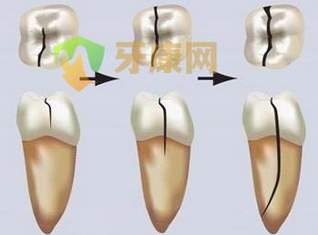 牙齿裂缝的原因