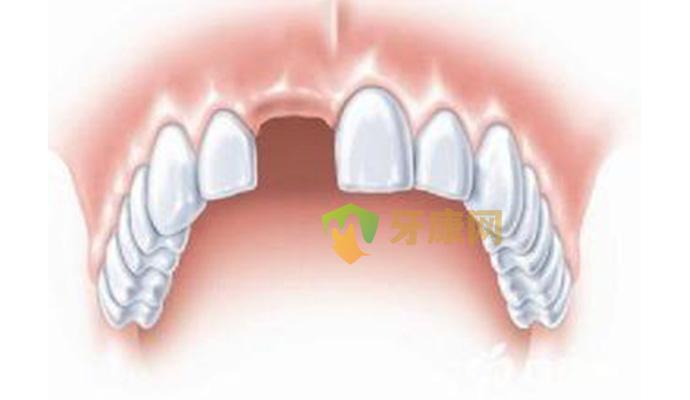 牙齿缺失要注意事项