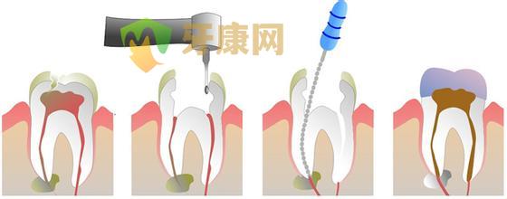 补牙多少钱