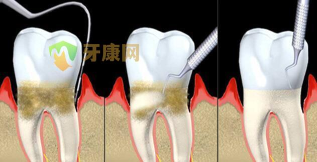 牙周炎的危害