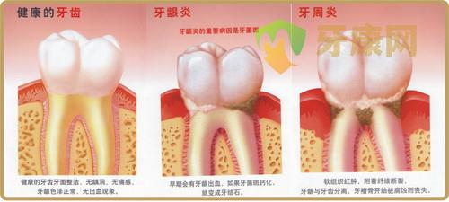 牙周炎的危害