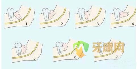 那种智齿需要拔掉