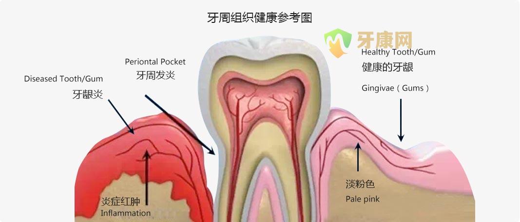 牙周病产生的原因