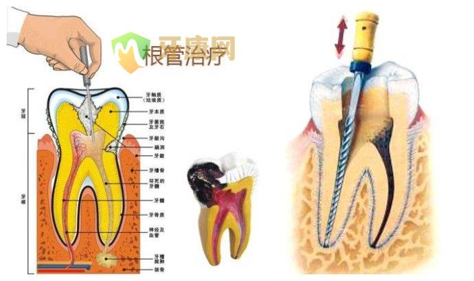 根管治疗的注意事项