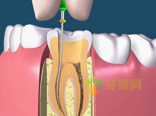 根管治疗的危害