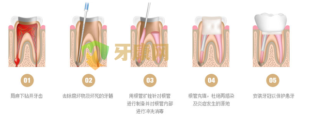 补牙为什么要做根管治疗