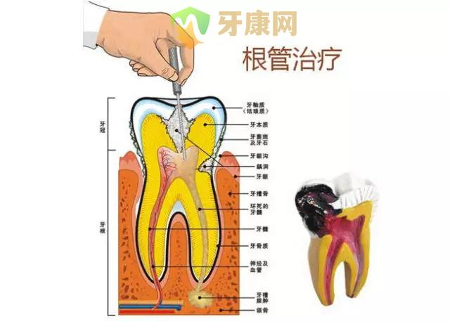 根管治疗的注意事项