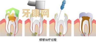 根管治疗需要多久