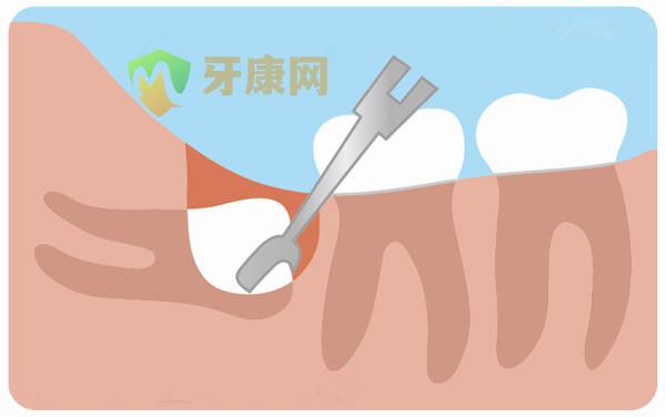 哪些智齿需要拔除