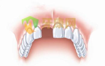 牙齿掉了不补会有什么不良影响