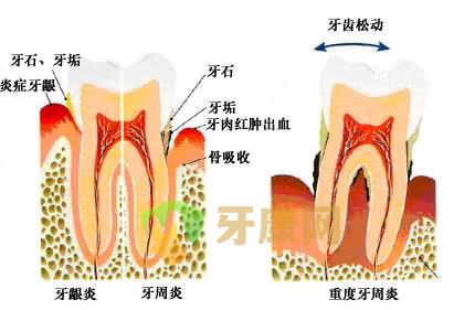 牙齿松动的原因