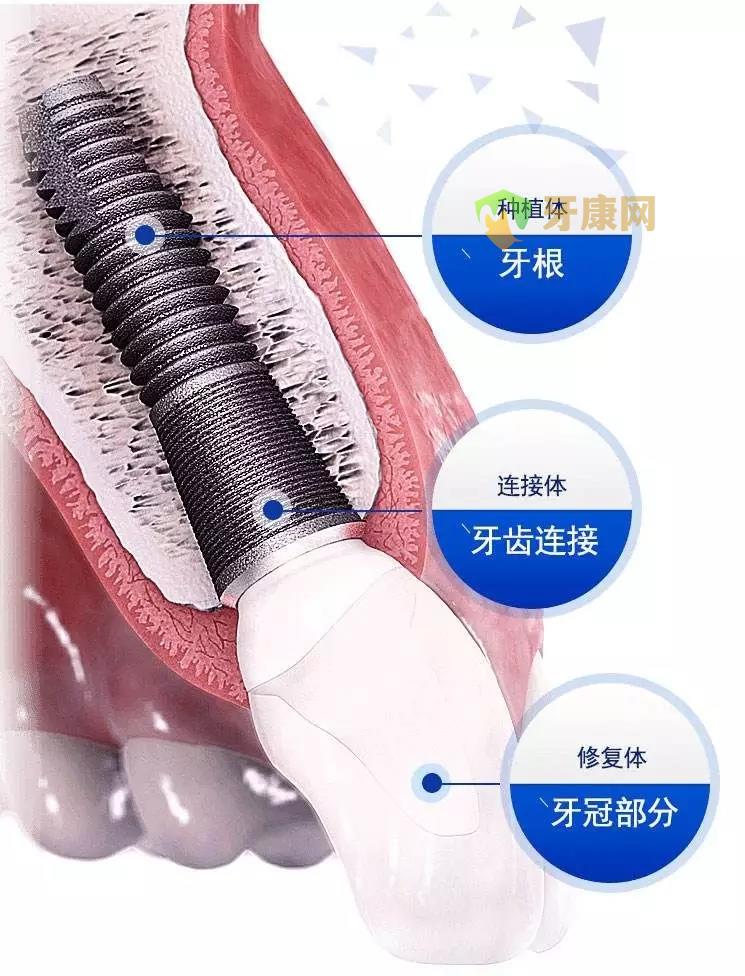 种植牙材料