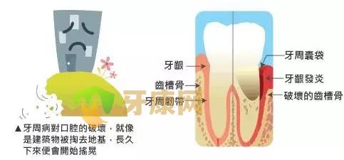 牙周病