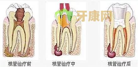 根管治疗