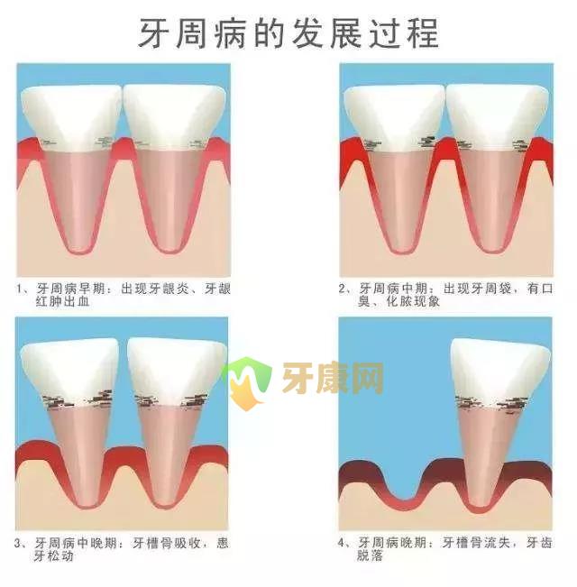 牙周病