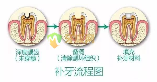 补牙流程