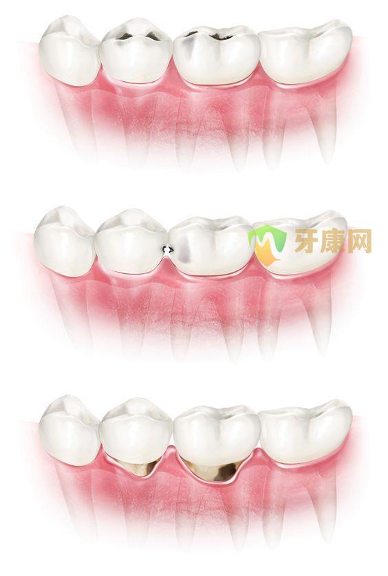 牙龈出血肿胀的主要原因是牙周炎？