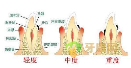 牙康网牙周炎发展过程