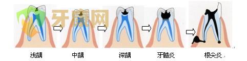 虫牙（蛀牙）是补牙好还是拔牙好？