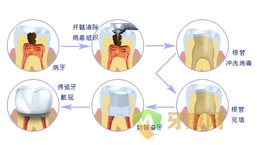 根管治疗的适应症有哪些