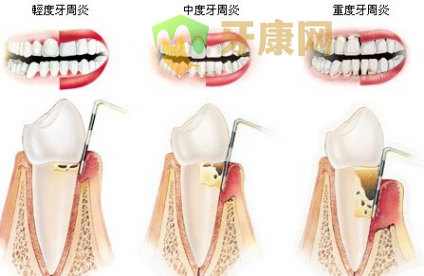 重度牙周炎如何治疗？