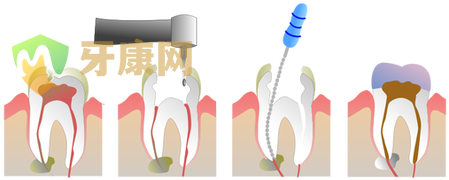 根管治疗过程和步骤