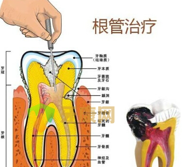 深圳根管治疗,根管治疗手术,根管治疗方法,根管治疗