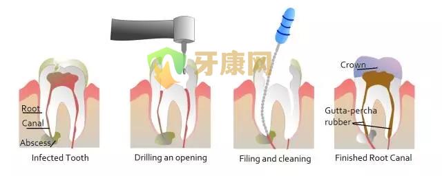 根管治疗